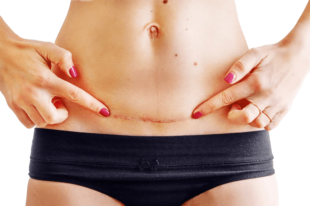 Scar treatment for surgical, traumatic and raised scars with dermatologic assessment and individualized treatment planning
