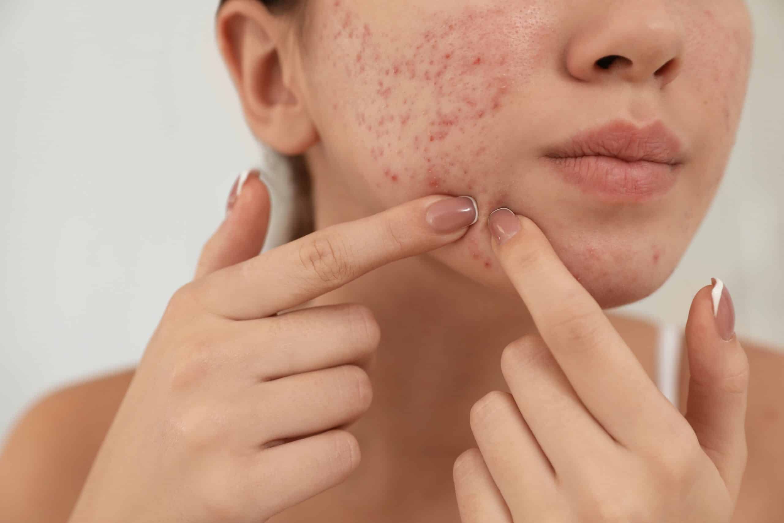 Acne and scar treatment by a dermatologist in Izmir – advanced medical and aesthetic dermatology