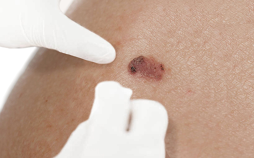 Deri kanseri tanı ve tedavisi – İzmir’de dermatolog muayenesi