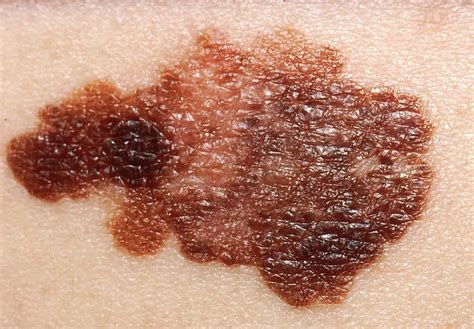 Dermatolog Dr. Orhan Demirer – Melanom Tedavisi