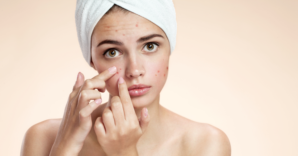 İzmir akne izi tedavisi lazer uygulamaları uzman dermatolog tarafından