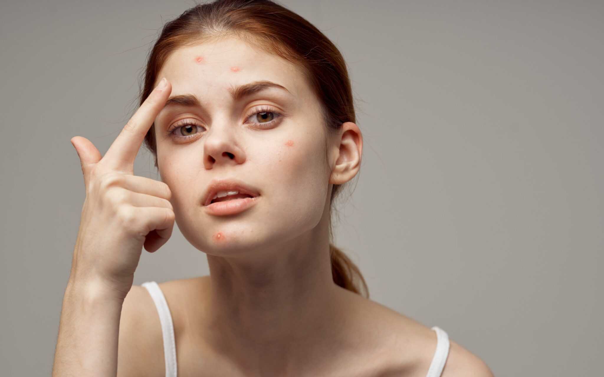 İzmir’de dermatolog tarafından uygulanan sivilce tedavisi
