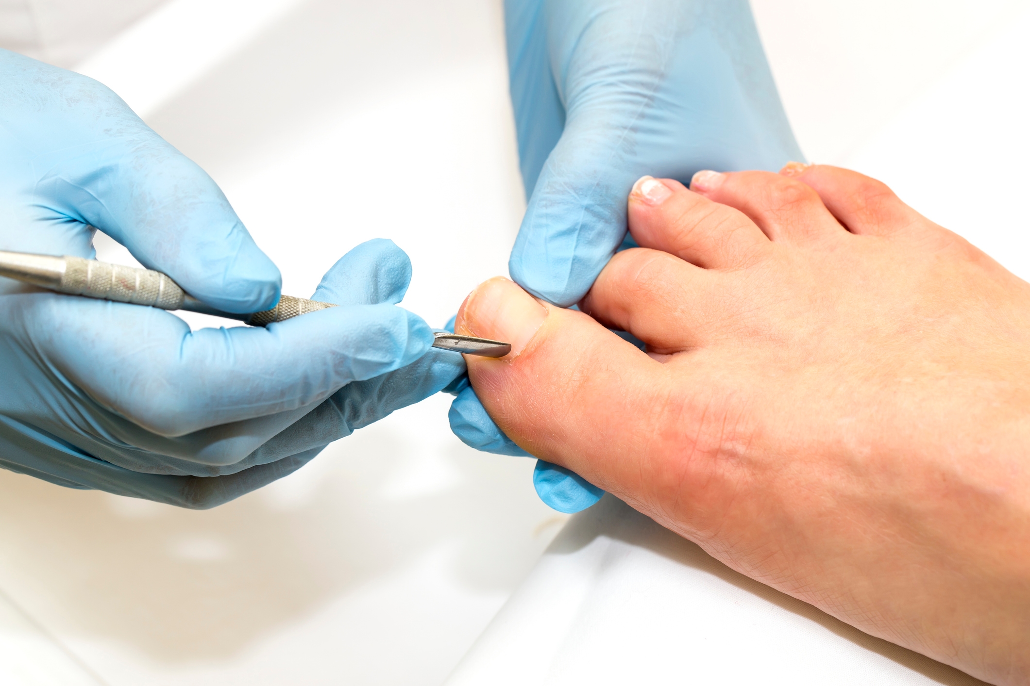 İzmir’de dermatolog tarafından uygulanan tırnak batması tedavisi