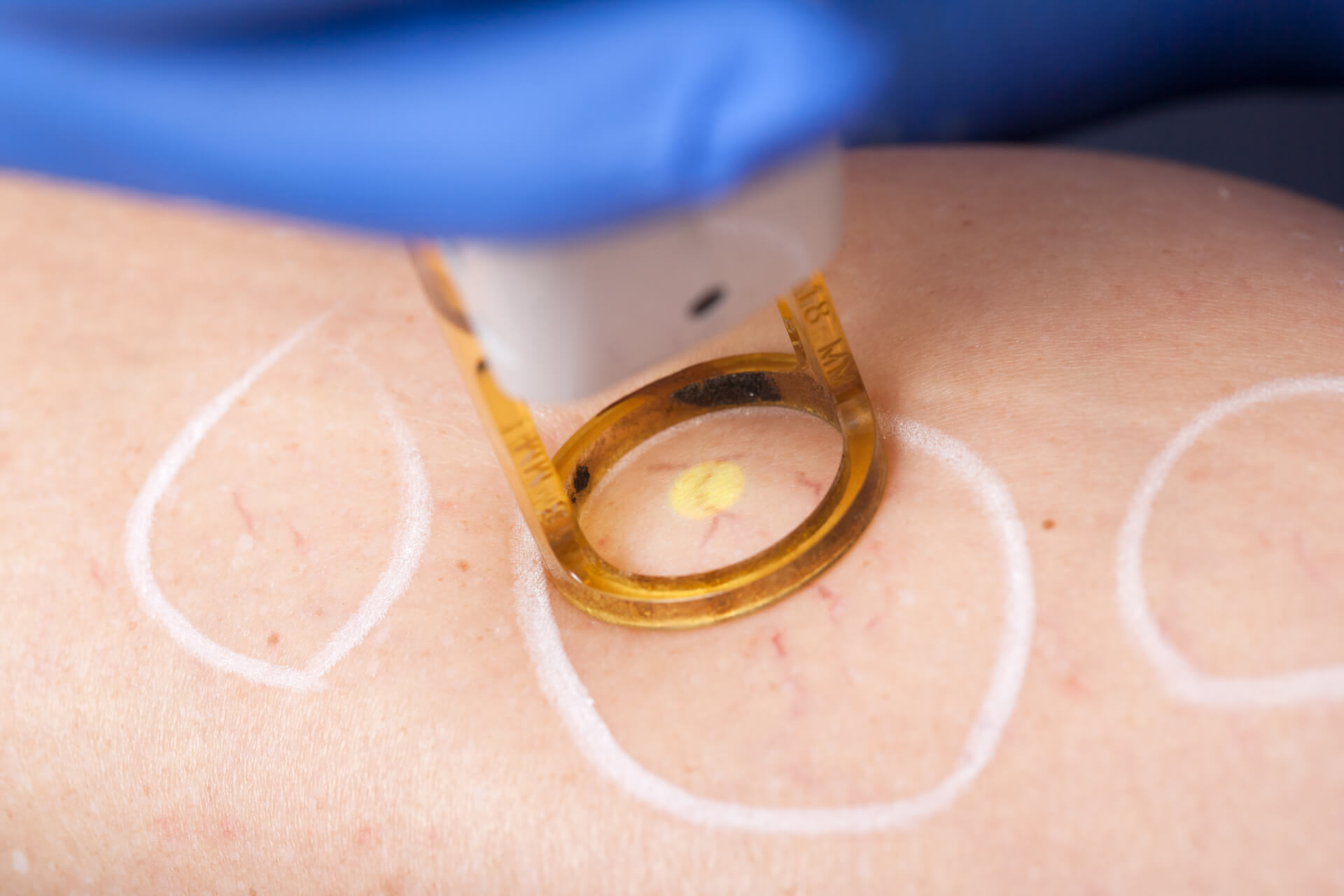 Laser vein treatment in Izmir for spider veins and visible capillaries performed by a dermatologist