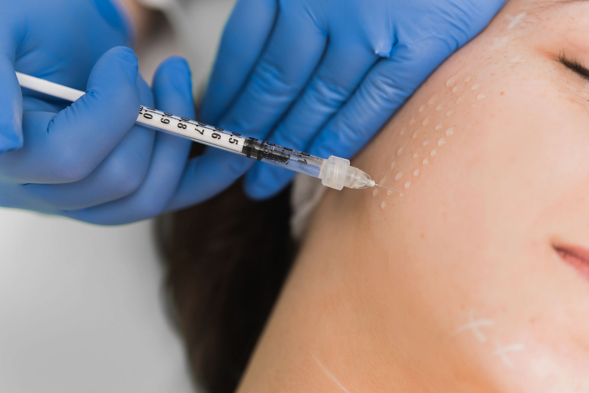 Mesotherapy treatment in Izmir for skin rejuvenation, hydration and hair support performed by a dermatologist