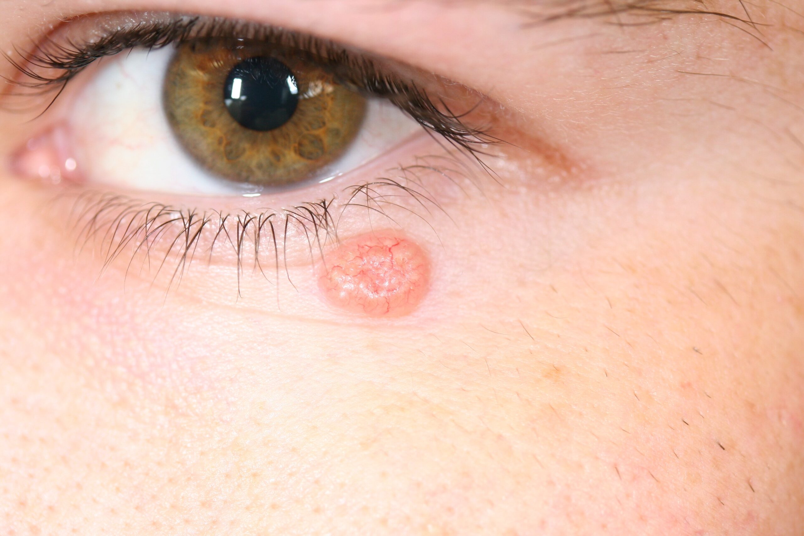 Molluskum Kontagiozum – Dermatoloji Kliniği