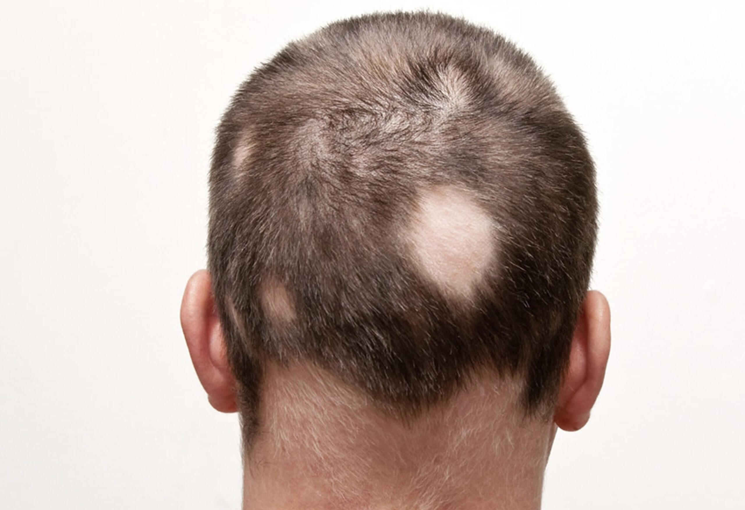 Dermatolog tarafından uygulanan saçkıran (alopecia areata) tedavisi