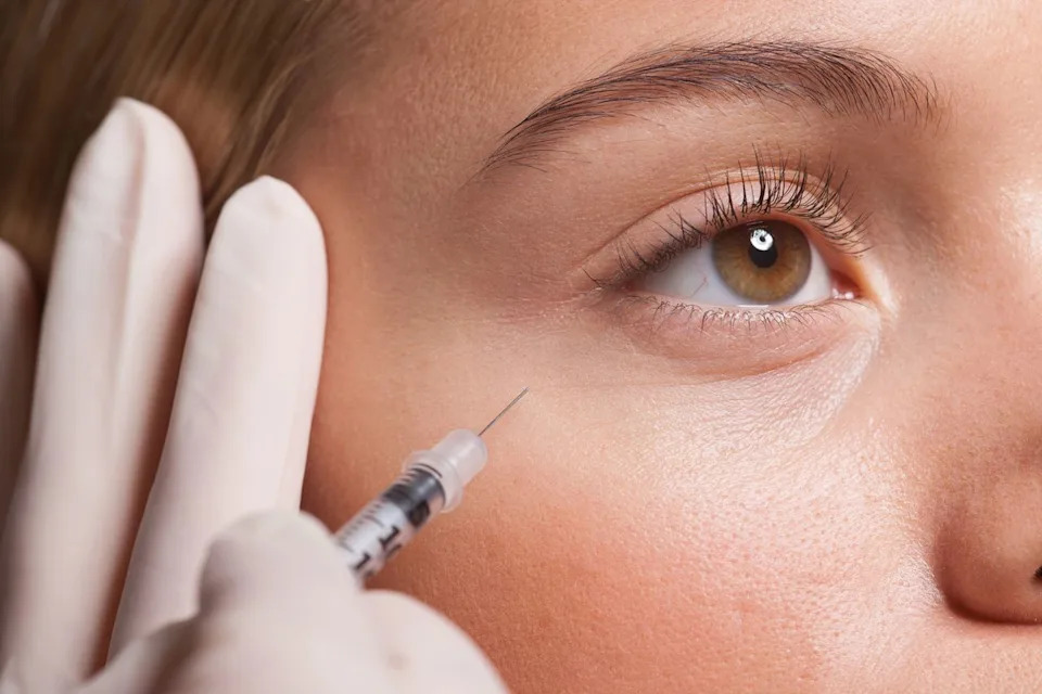 Under-eye filler treatment in Izmir for dark circles, hollows, and tear troughs performed by a dermatologist
