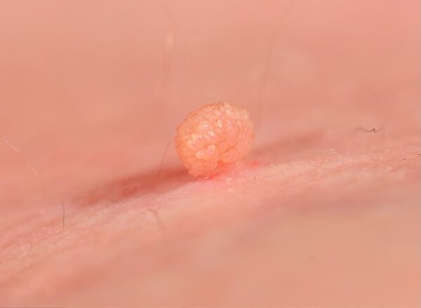 Wart treatment in Izmir using medical and laser methods performed by a dermatologist