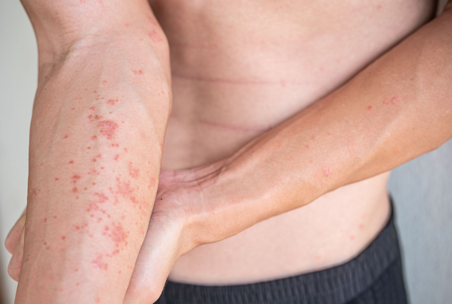 Atopische Dermatitis mit trockener, geröteter und juckender Haut