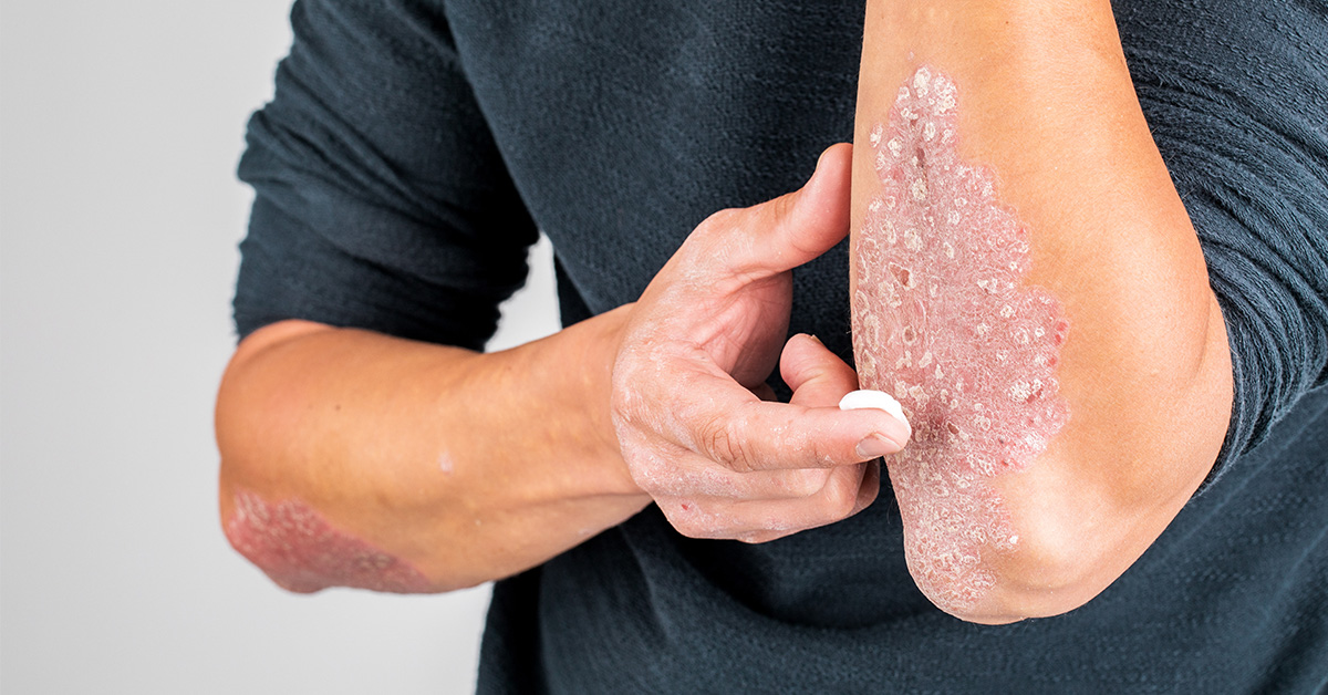 Psoriasis mit geröteten und schuppenden Hautplaques