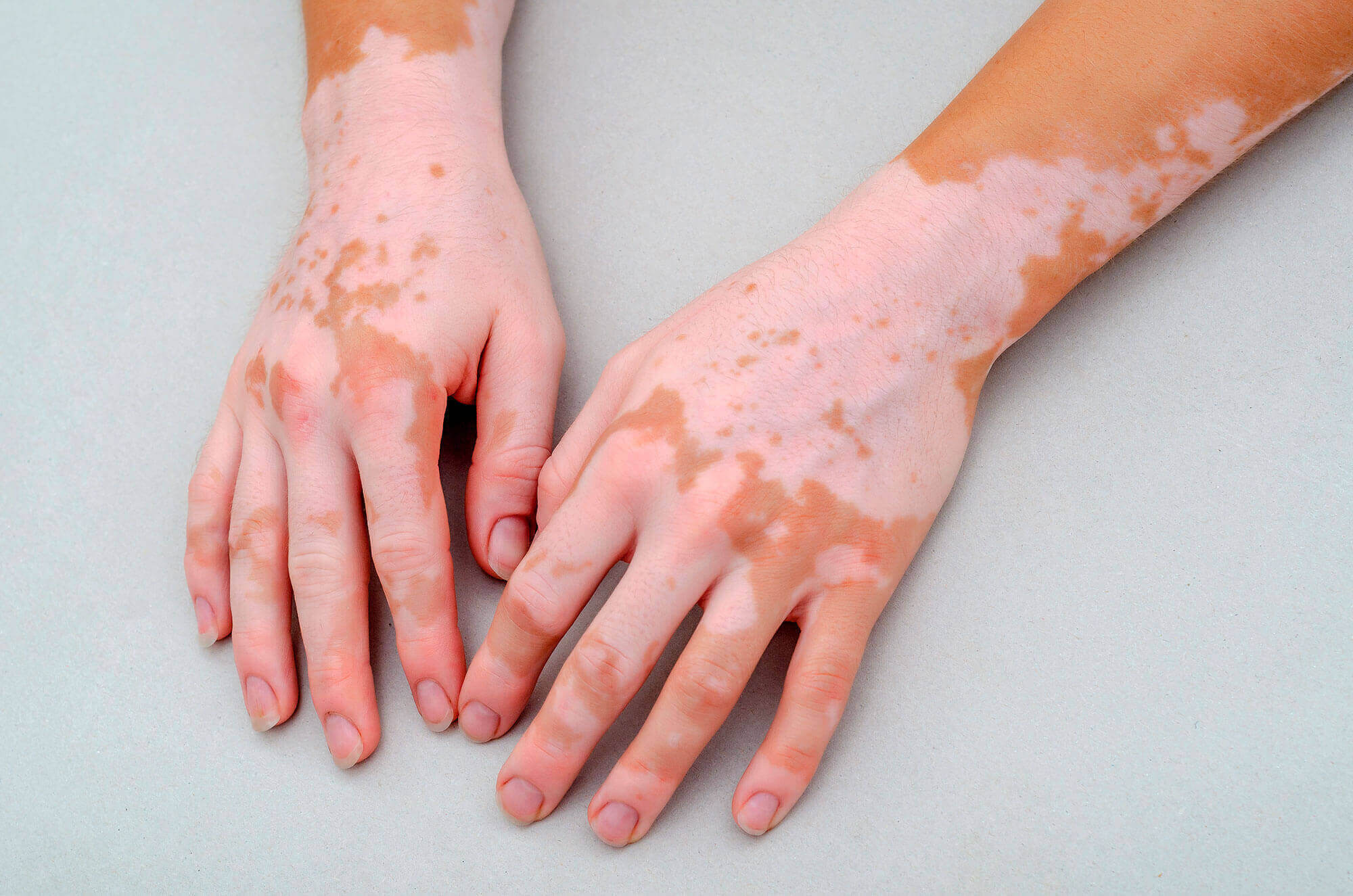Vitiligo mit umschriebenen Bereichen von Pigmentverlust